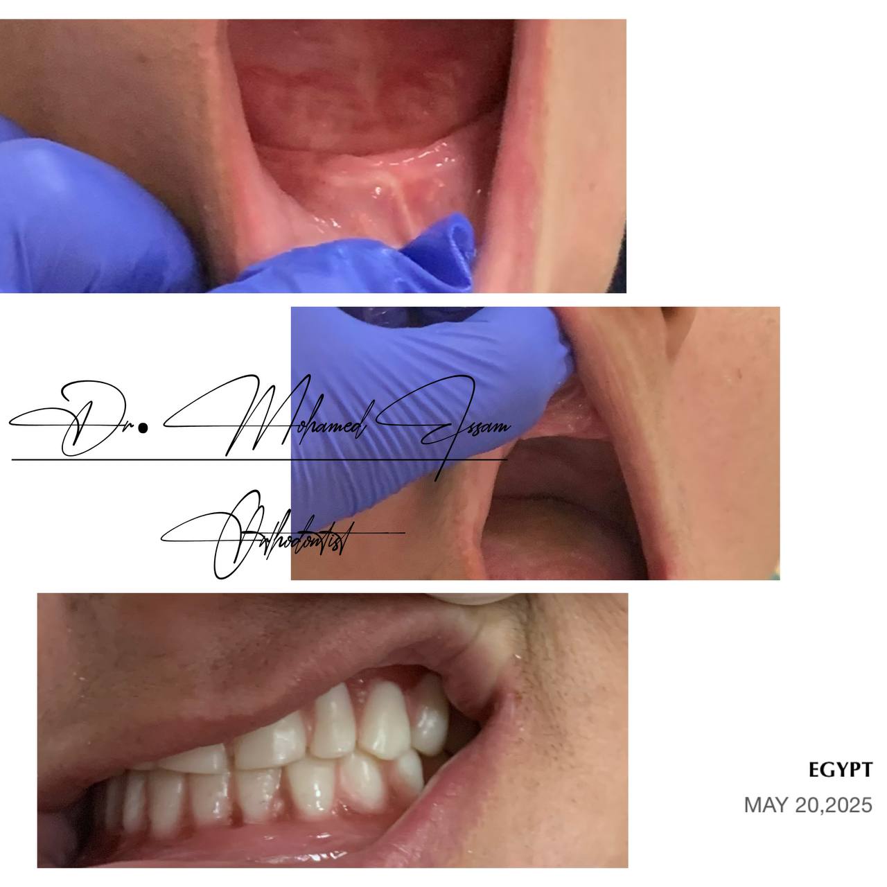 Removable denture